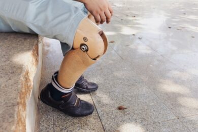 The poor amputee with his old prosthesis using