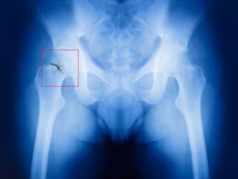 X-ray of a broken hip